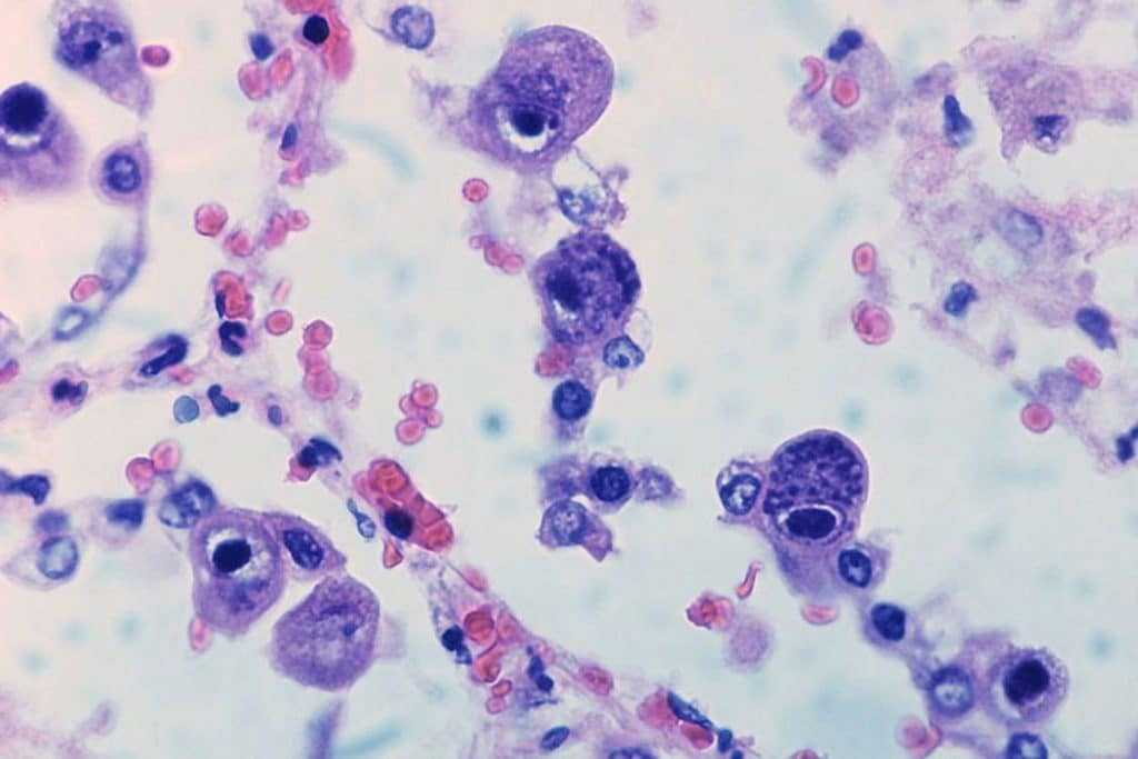 Цитомегаловирус в микроскопе