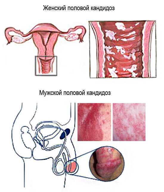 Молочница у мужчин является заболеванием грибковой этимологии (кандидоз), которое приводит к поражению слизистых оболочек и кожи наружных половых органов. 
