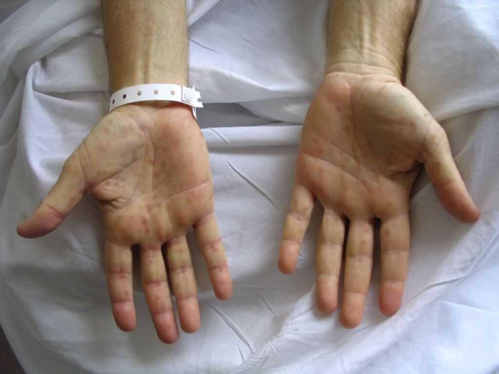 сифилис на руках