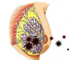 Мастит Молочной Железы Фото