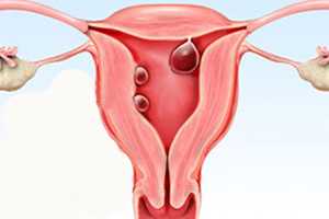 Гиперплазия яичника в менопаузе