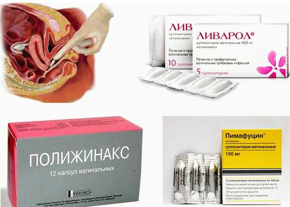 Эффективные недорогие свечи от молочницы у женщин | boleznimatki.com