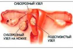 Симптомы и признаки субсерозной миомы матки