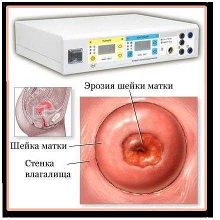 Выпадение Шейки Матки У Женщин Фото