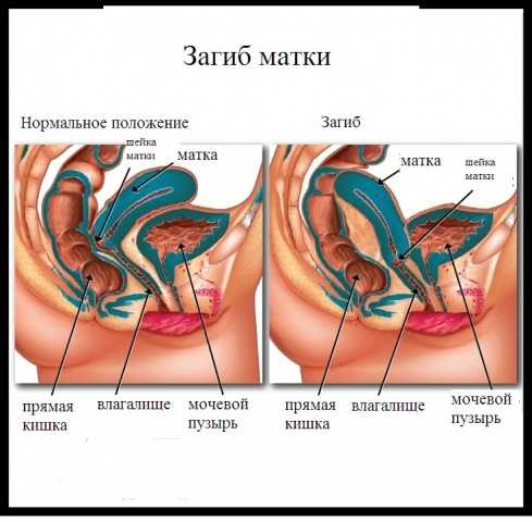 Загиб матки: причины, симптомы, лечение