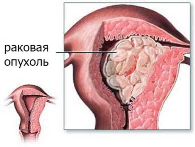 Чем отличаются месячные от кровотечения при климаксе