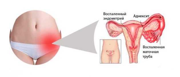 Воспаление яичников: лечение народными средствами