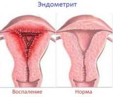 Симптомы воспаления матки