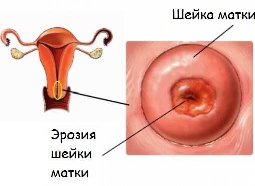 Гипоэхогенное образование в матке миома