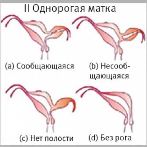 Какой удалить матку. Однорогая матка с рудиментарным. Однорогая матка с рудиментарным рогом. Однорогая и двурогая матка. Аномалия развития матки однорогая.