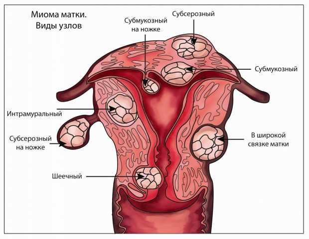 Симптомы интралигаментарной миомы матки