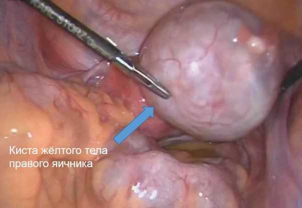 Геморрагическая киста яичника
