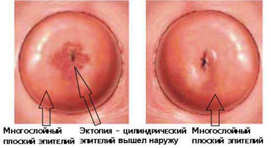 Можно ли использовать флуомизин при эрозии