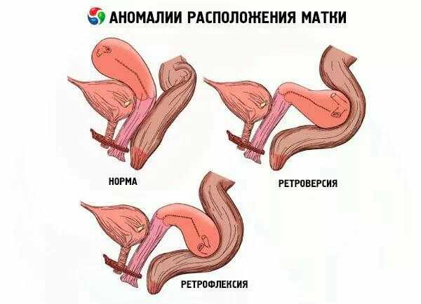 что значит матка расположена высоко. Смотреть фото что значит матка расположена высоко. Смотреть картинку что значит матка расположена высоко. Картинка про что значит матка расположена высоко. Фото что значит матка расположена высоко