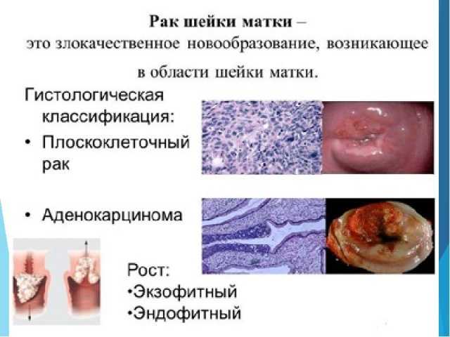 Рак шейки матки фотографии