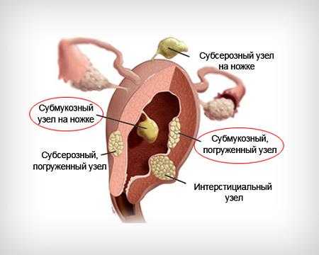 Миоматозный узел по задней стенке что это