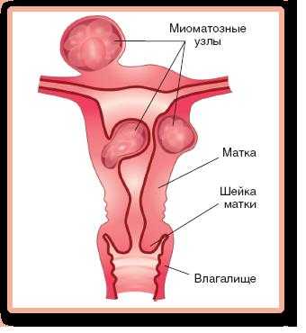 Тихомиров о миоме матки