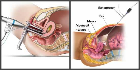 Киста (правого, левого) яичника: лечение, последствия, фото