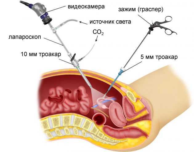 Лапароскопия яичников (удаление кисты)