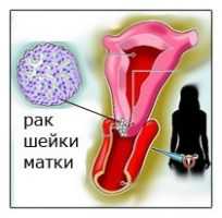 Инвазивный рак шейки матки