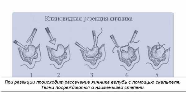 Синдром склерокистозных яичников