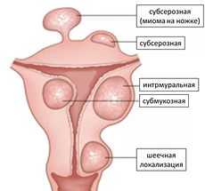 Симптомы интралигаментарной миомы матки