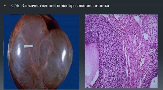 Герминогенные опухоли яичников