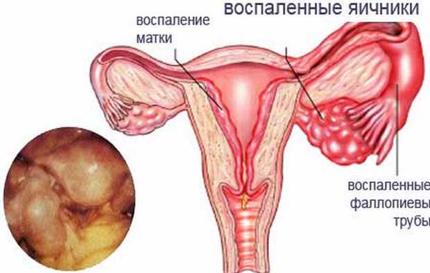 Гипофункция яичников у женщин