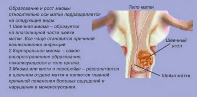 Узел в матке что это как