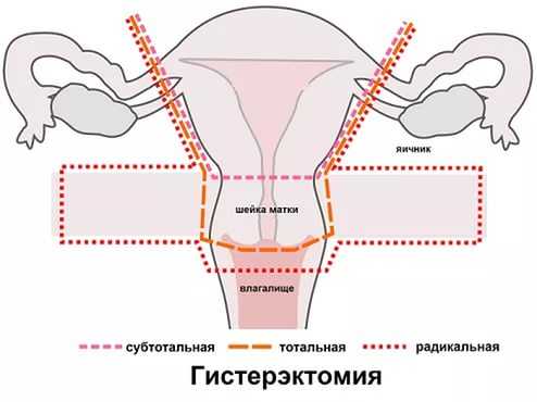 Тихомиров о миоме матки