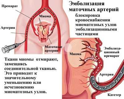 Тихомиров о миоме матки