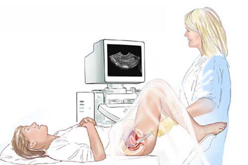 Дисфункция яичников: симптомы и методы лечения