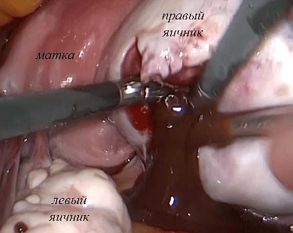Эндометриоидная киста левого и правого яичника