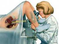Как проходит процедура кольпоскопия шейки матки