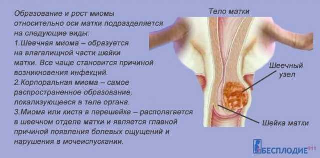 Симптомы интралигаментарной миомы матки thumbnail