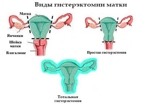 Субтотальная гистерэктомия презентация