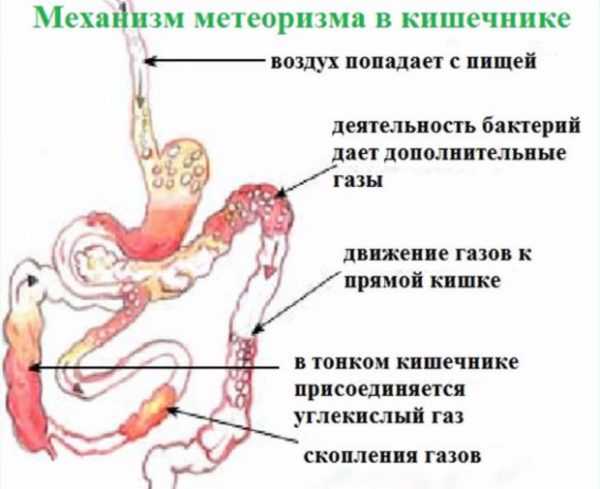 Схематическое описание метеоризма в кишечнике