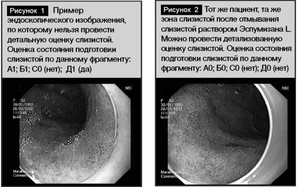 Сравнение эндоскопических изображений слизистой оболочки брюшной полости без предварительного приёма Эспумизана и с предварительным приёмом