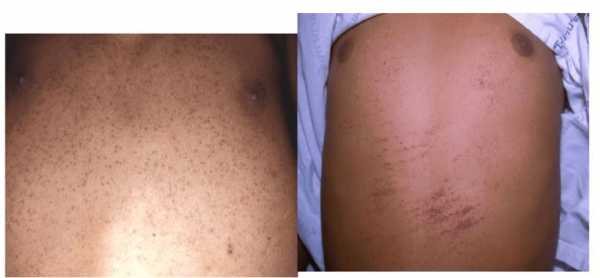 Проявление признаков геморрагического синдрома кожных покровов