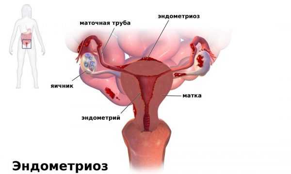 Схема матки с эндометриозом