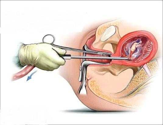 Инструментальный аборт