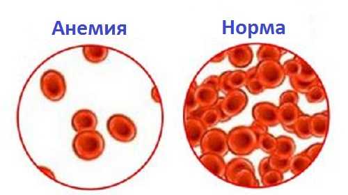 Количество гемоглобина при анемии и в норме