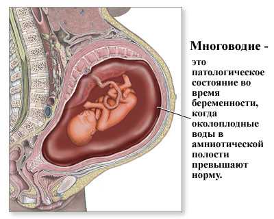 Многоводие — патология беременности