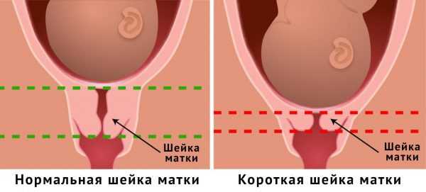 Наглядное изображение нормальной и укороченной шейки матки при беременности