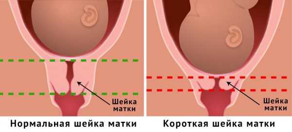 Нормальная и укороченная шейка матки при беременности