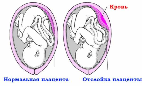 Нормальная плацента и её отслойка на рисунке
