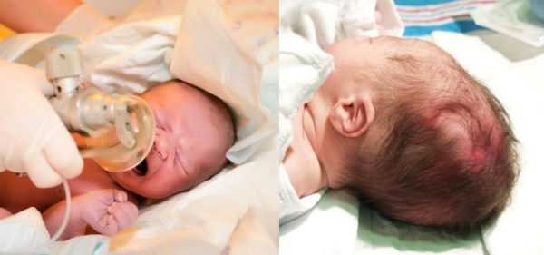 Новорождённому ставят аппарат искусственного дыхания, гематома на голове у новорождённого