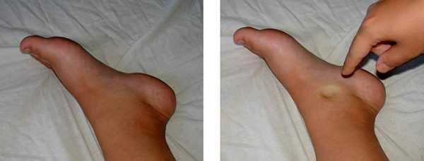 Отёчные ноги беременной