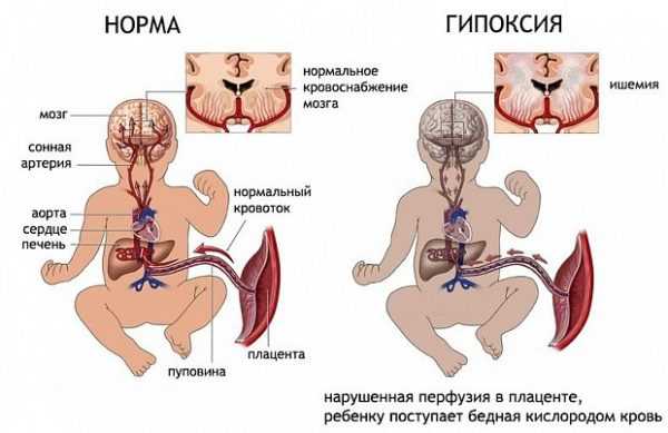 Сравнение в рисунках нормального и нарушенного кровоснабжения мозга плода при гипоксии из-за плацентарной недостаточности