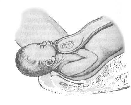 Ребенок рождается при переднеголовном положении